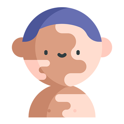 Vitiligo