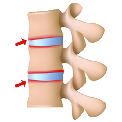 Ankylosing Spondylitis